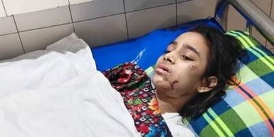 গৃহকর্মী কল্পনার ক্ষতস্থানে অস্ত্রোপচার, লাগানো হবে কৃত্রিম দাঁত