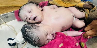 জোড়া মাথা নিয়ে জন্ম নেওয়া নবজাতকের মৃত্যু