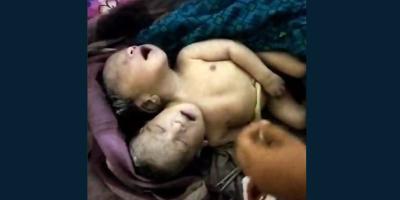 শার্শায় ২ মাথা নিয়ে জন্ম নেওয়া শিশুর মৃত্যু