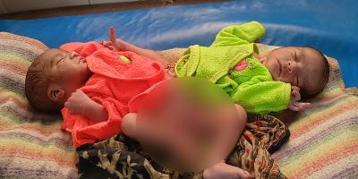 মাগুরায় ৩ পা নিয়ে জোড়ালাগা শিশুর জন্ম