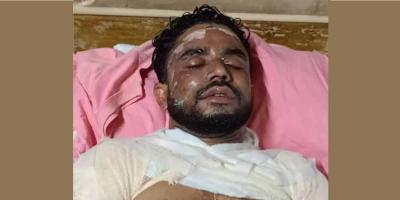 গরম তেল ছুড়ে বাবাকে দগ্ধ করলেন মেয়ে