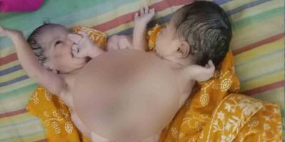 চাঁদপুরে দুই মাথা নিয়ে শিশুর জন্ম