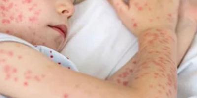 হাম ও উপসর্গে আরও ৫ শিশুর মৃত্যু